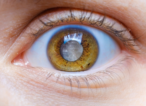 Troubles de la réfraction